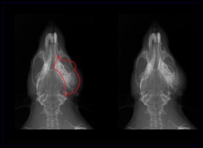 Radio d'une tumeur de la glande de Zymbal